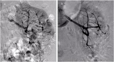 Urgent Transcatheter Arterial Embolization for Wunderlich Syndrome With Hypovolemic Shock Secondary to Ruptured Renal Angiomyolipoma